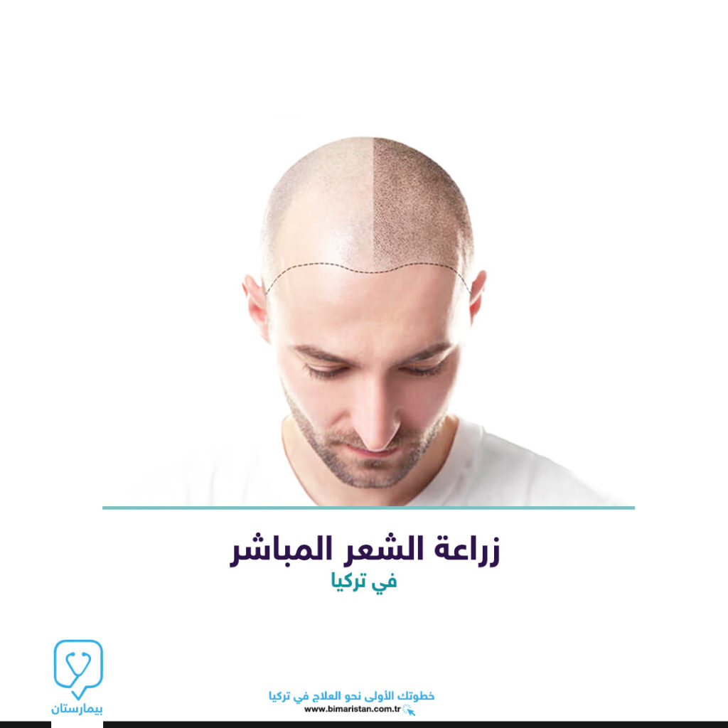 زراعة الشعر المباشر بالاقتطاف في تركيا