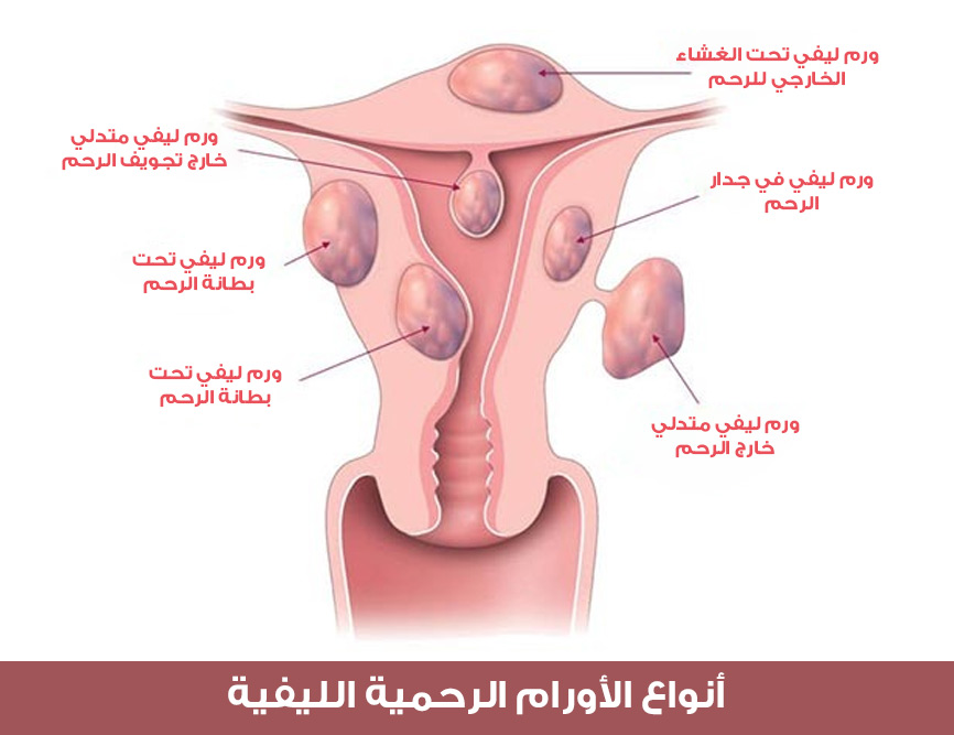 صورة تبين الأنواع المختلفة للأورام الرحمية الليفية ومكان توضعها