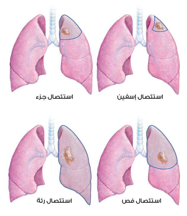 Dört yaygın akciğer kanseri cerrahi tedavisi (rezeksiyon) tipini gösteren resim