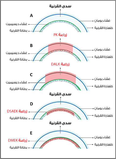 صورة تبين أنواع عملية زراعة القرنية في تركيا