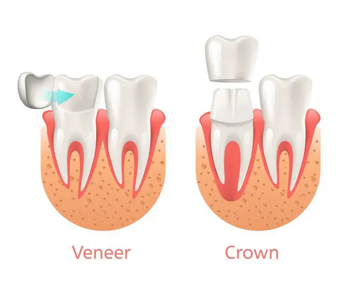 Types of dental crowns are crowns and veneers