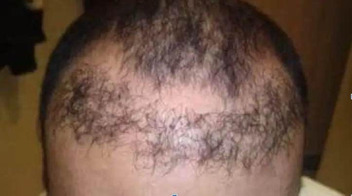 Bad hair shape after an unfavorable hair transplant due to the doctor’s lack of experience