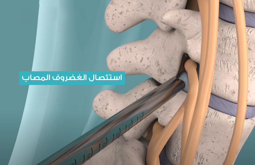 Laparoscopic herniated disc resection