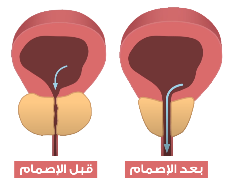 Prostate coagulation is one of the most effective prostate enlargement treatment methods used in Turkey