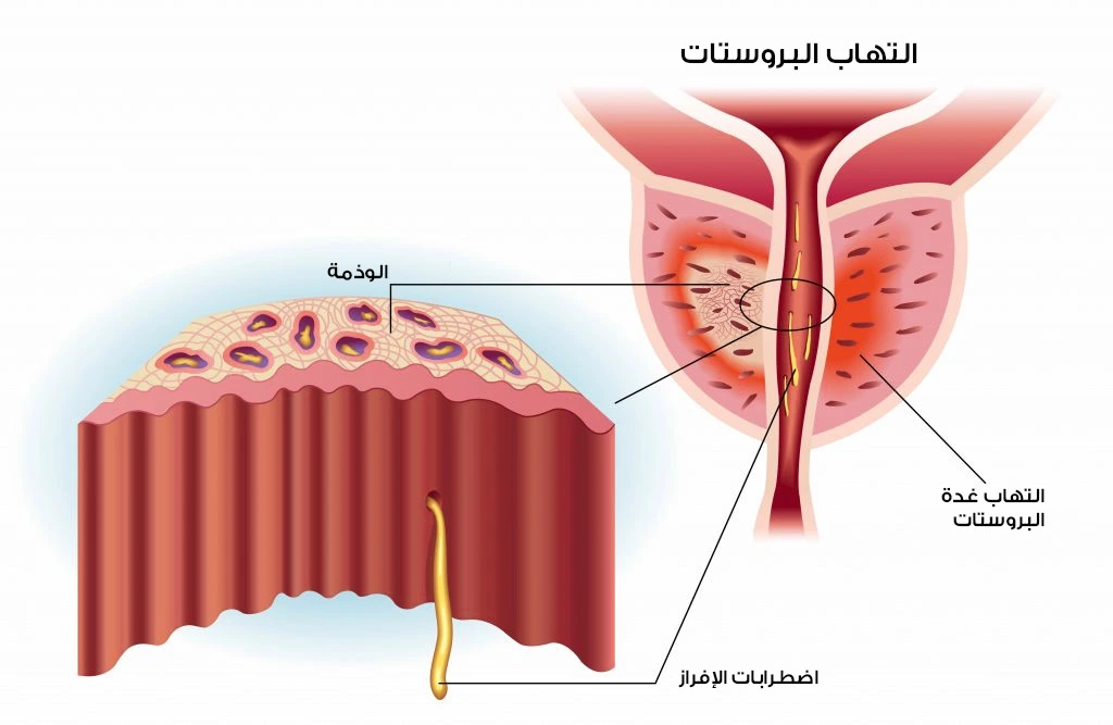 Inflamed and swollen prostate gland