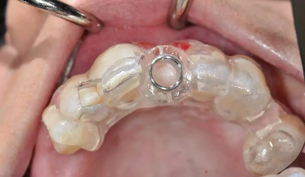زراعة الأسنان بدون جراحة في تركيا