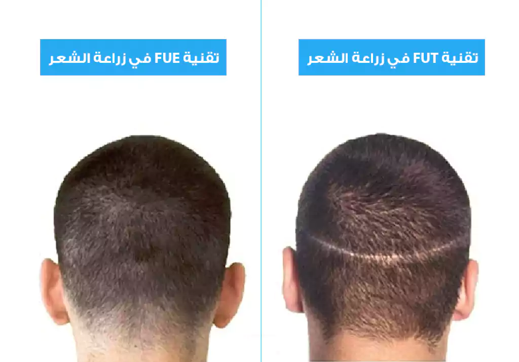 الفرق التجميلي بين تقنية FUT و FUE في زراعة الشعر
