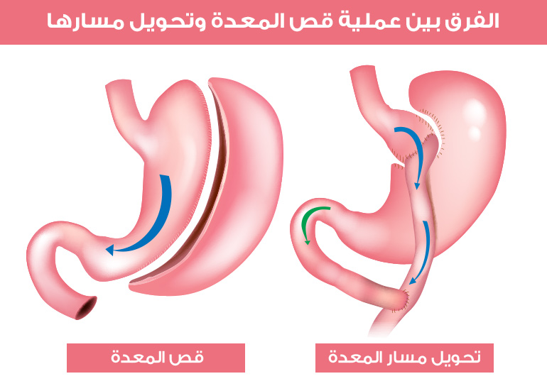 On the right side, the picture shows gastric bypass, while on the left side, the gastric bypass operation