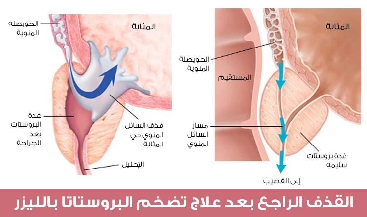 Retrograde ejaculation after laser treatment for prostate enlargement