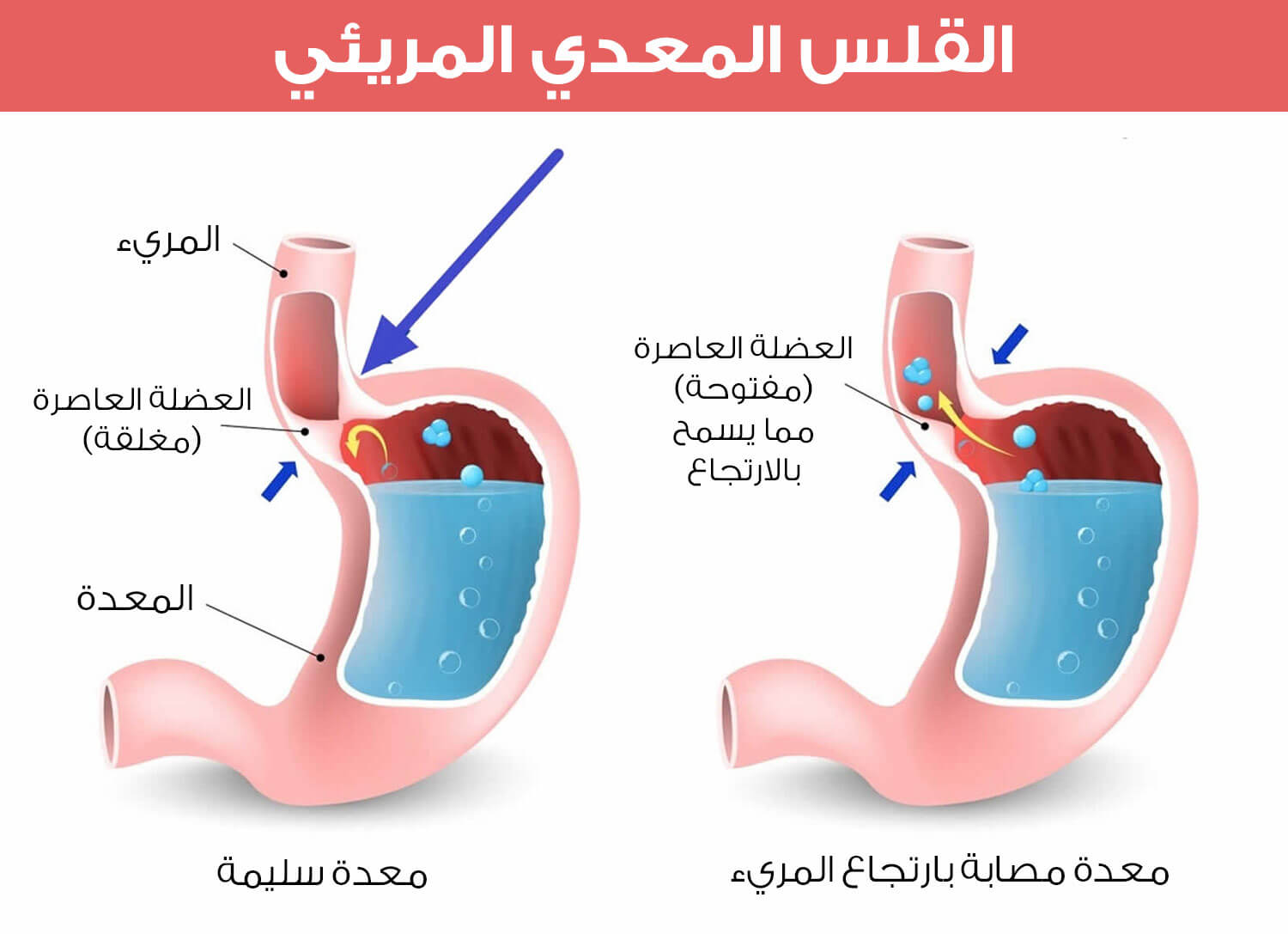 An image showing the difference between a healthy stomach and a stomach with an open sphincter, which allows reflux into the esophagus