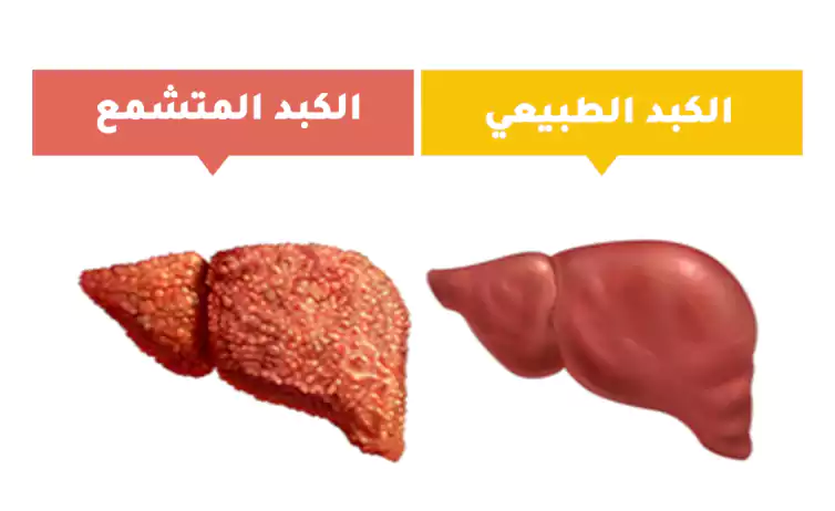 Normal liver and cirrhotic liver