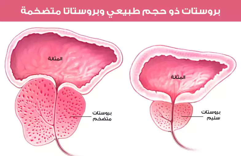 Comparison between the normal size of the prostate and an enlarged prostate