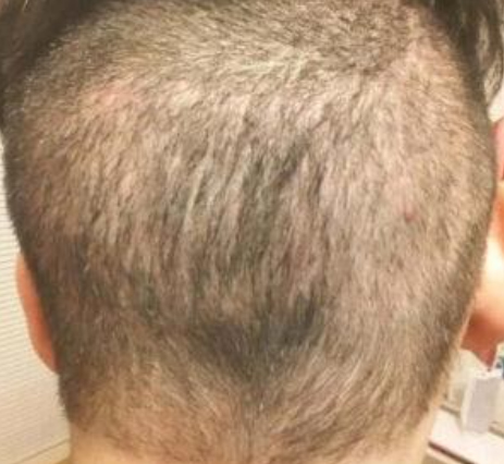 Picture of alopecia after hair transplant surgery