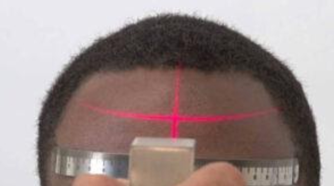 Determining the frontal line by laser to know the number of hairs to be extracted