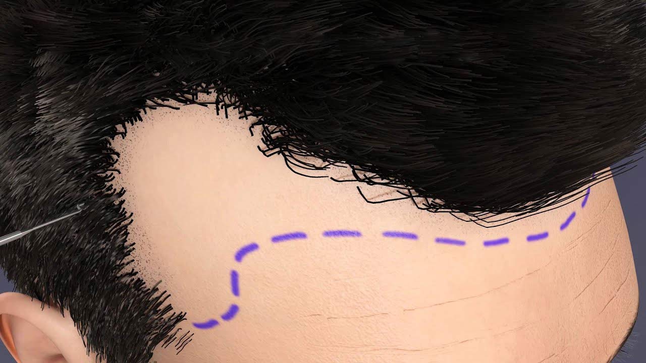 صورة لتحديد خط الشعر قبل زراعة الشعر بواسطة NeoGraft