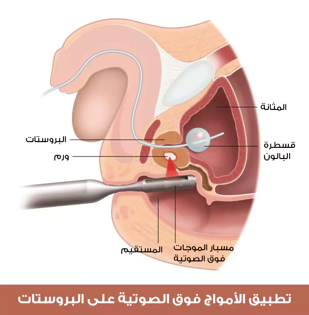 Türkiye'de prostat hipertrofisi tedavisi için ultrason uygulaması