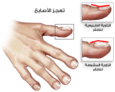صورة تبين انتفاخ الأصابع وإذا حدثت بشكل سريع يمكن أن نشك بسرطان الرئة