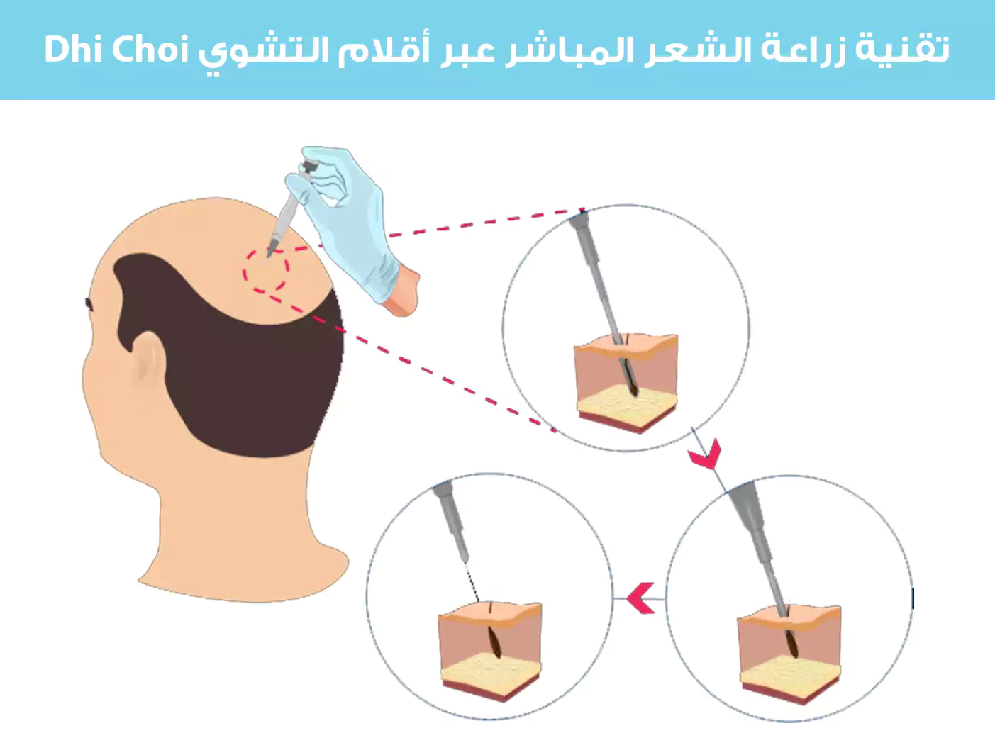 Dhi Choi kalemleri kullanılarak direkt saç ekimi tekniğini gösteren bir görsel