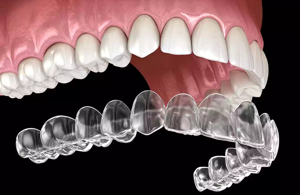 تقويم الأسنان الشفاف في علاج الأسنان