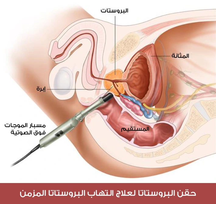 Prostate injection to treat chronic prostatitis