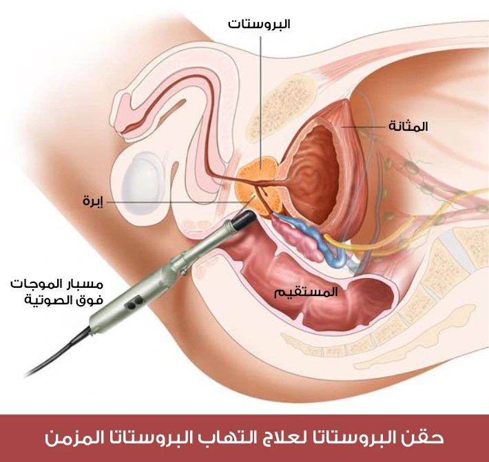 حقن البروستاتا لعلاج التهاب البروستاتا المزمن