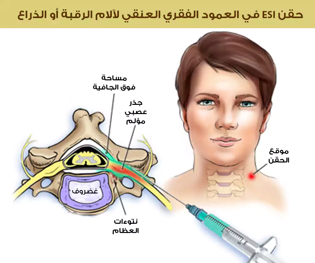 Steroid injections into the cervical spine in Turkey for neck and arm pain