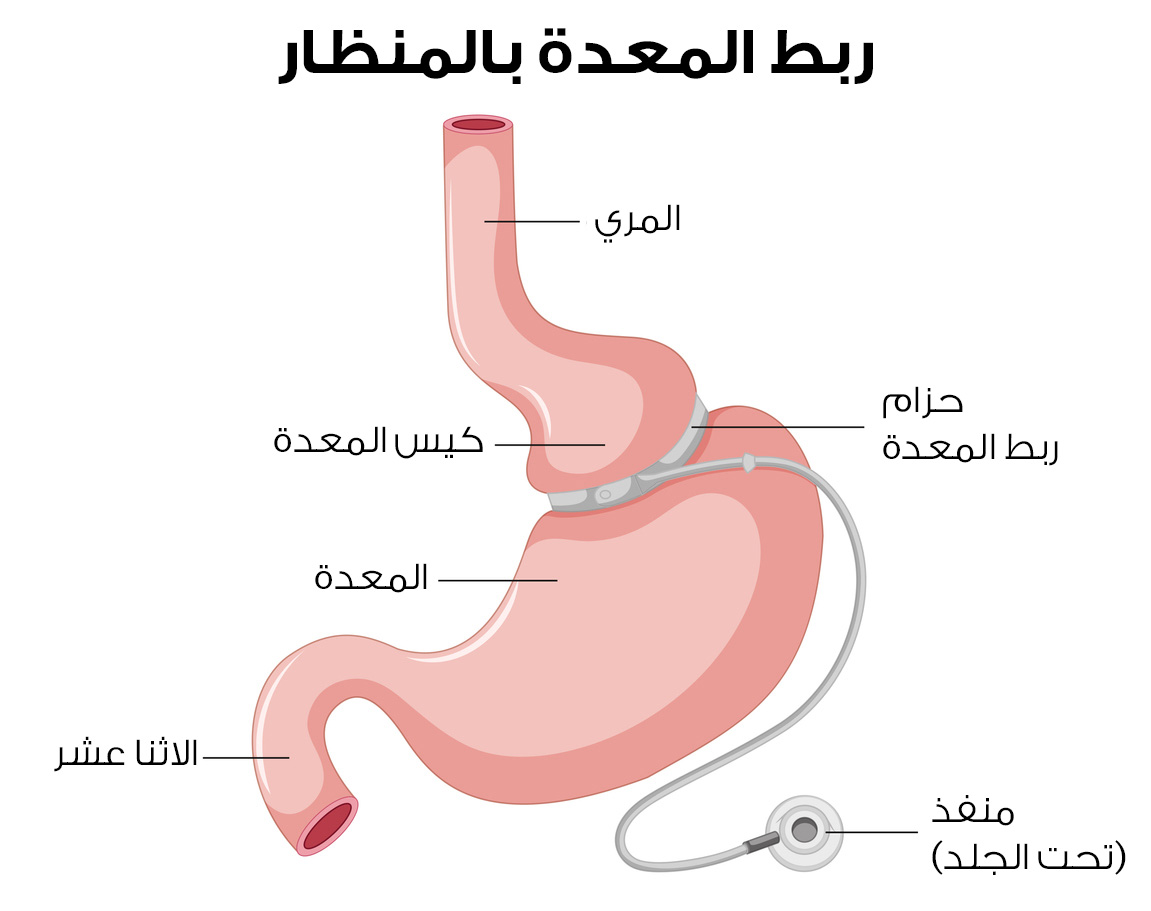 Laparoskopik mide bandı