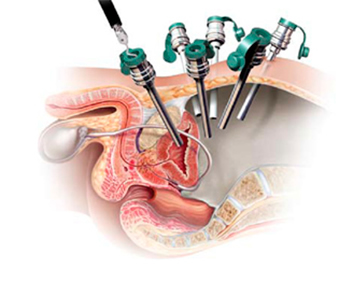 Picture showing the operation of prostatectomy by robot
