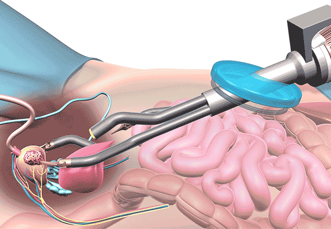 Animation showing a robotic prostatectomy