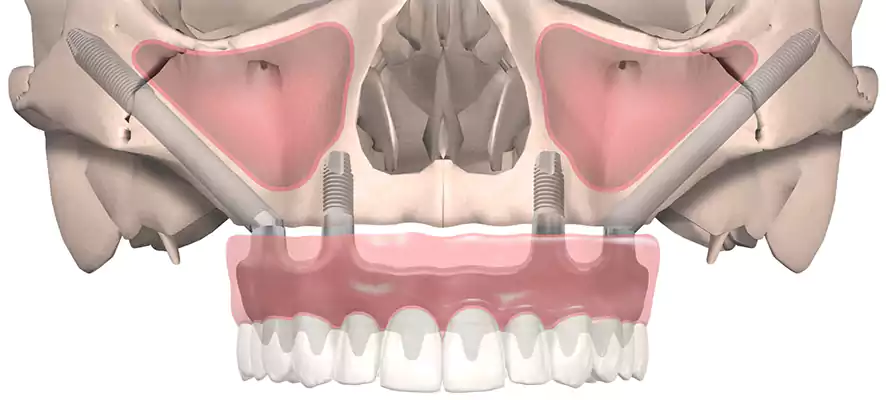 زراعة الأسنان بتقنية الكل على أربع مع تجنب الدخول في الجيب الفكي العلوي