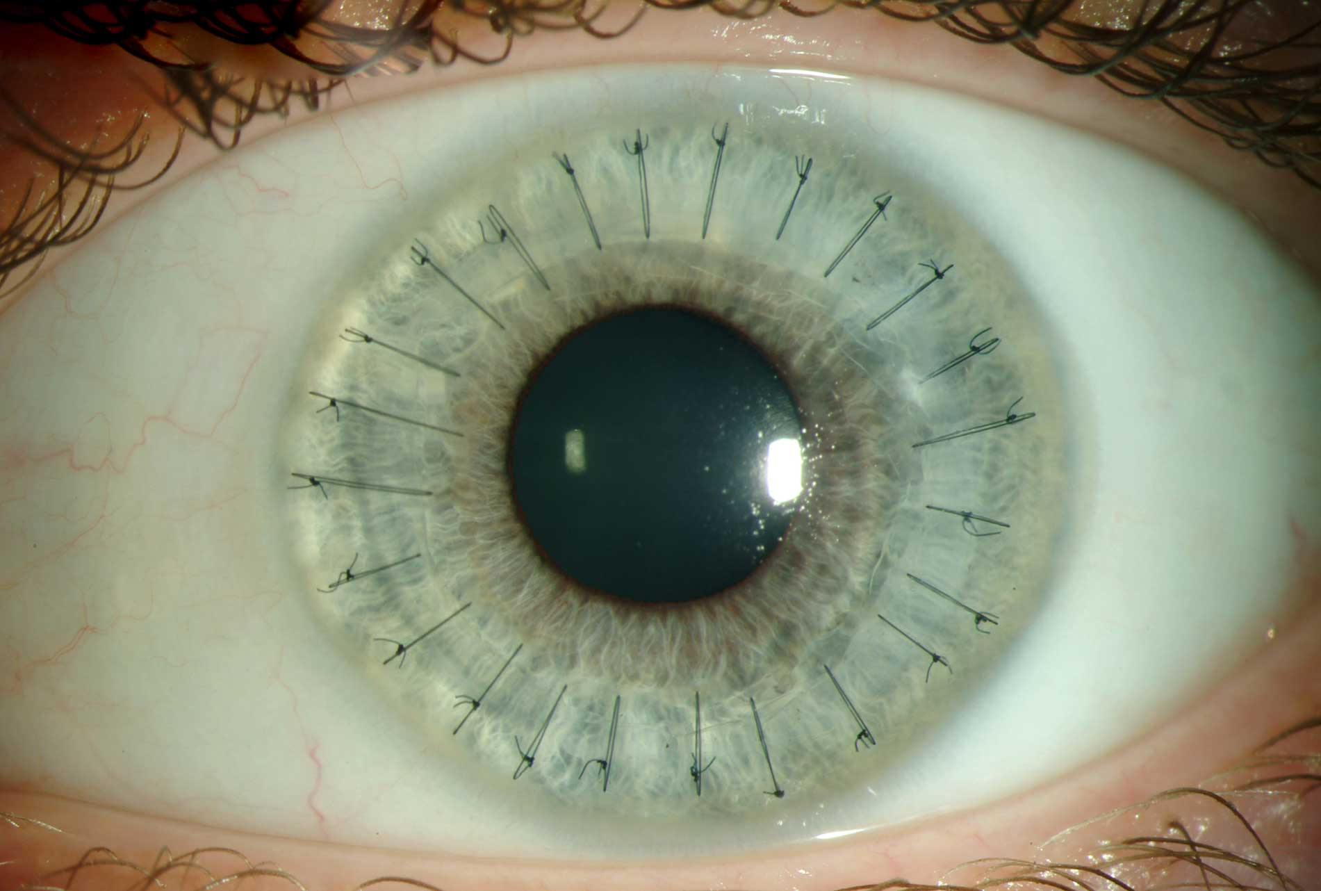 Picture showing full thickness corneal transplantation in Turkey