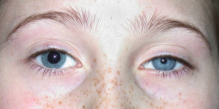 An image showing Horner's syndrome and eyelid ptosis as a symptom of basal lung cancer