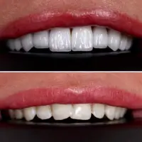 Teeth in good quality veneers