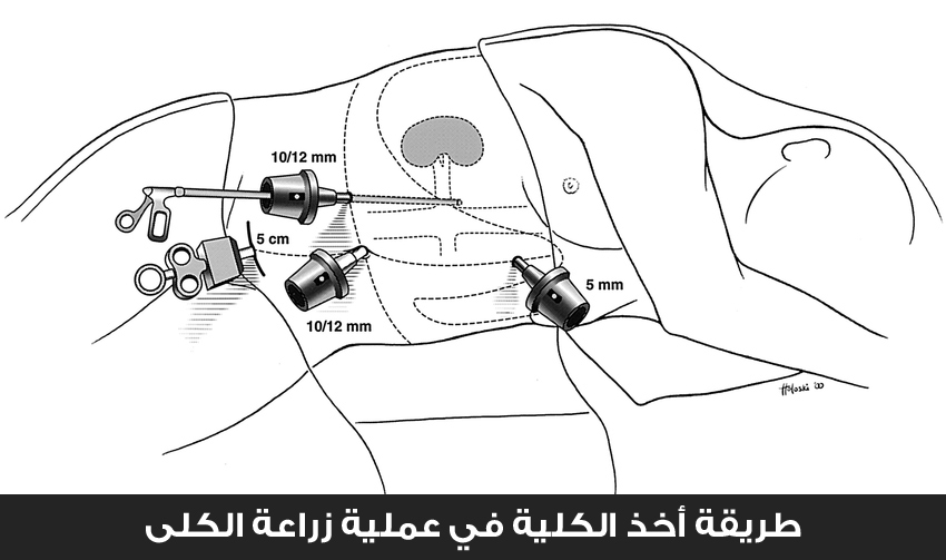 طريقة أخذ الكلية في عملية زراعة الكلى