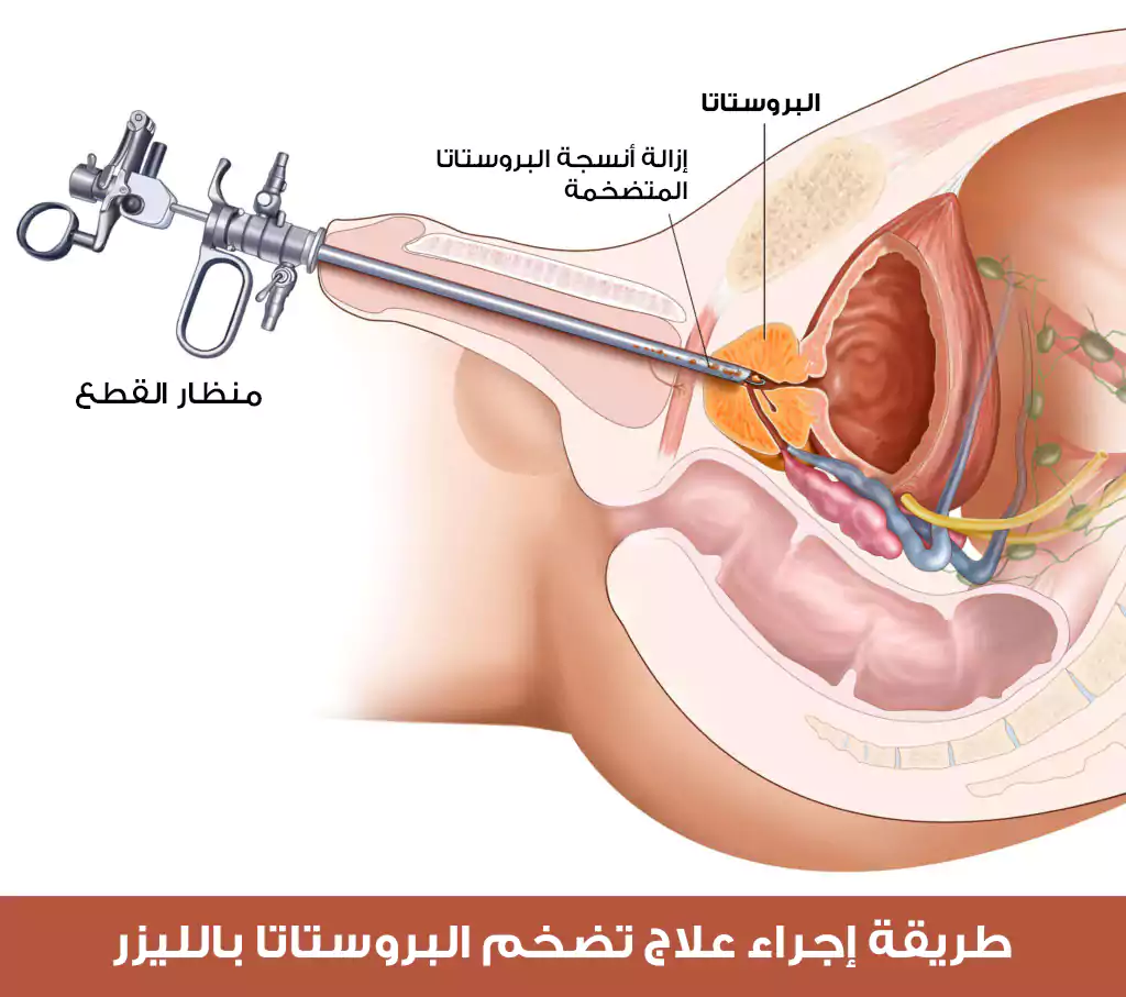 Treatment of enlarged prostate by laser application