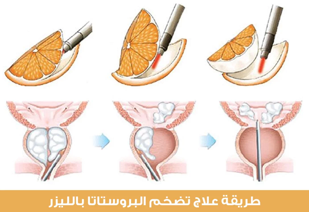 The method of treating prostate enlargement with laser and emptying its contents as an orange peels