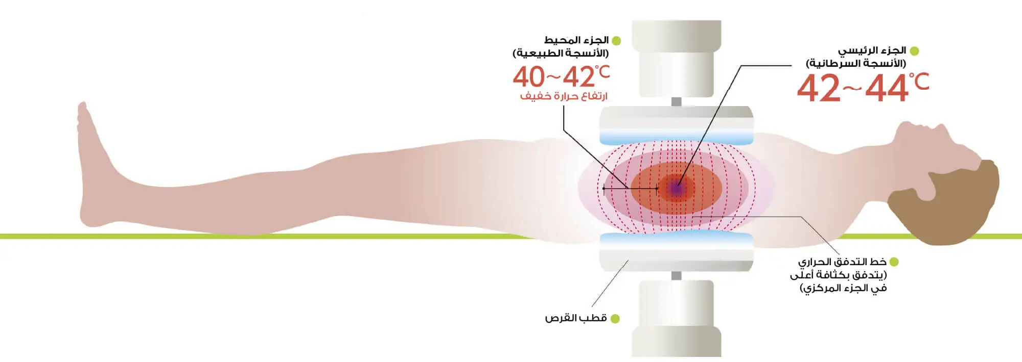 A picture of the mechanism of action of cancer heat therapy and focusing the heat on the tumor area