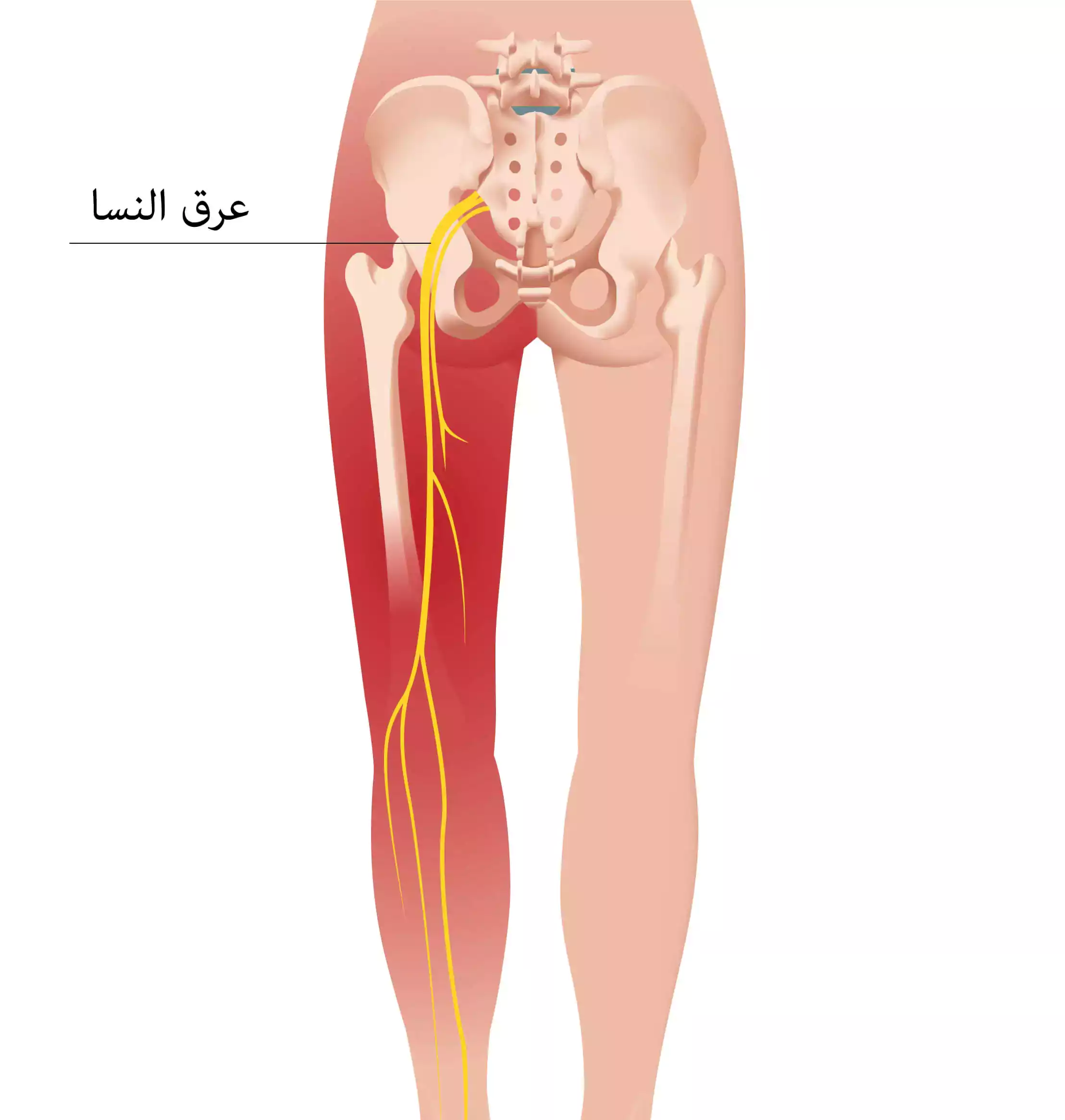 Extension of sciatica pain that extends along the path of the sciatic nerve