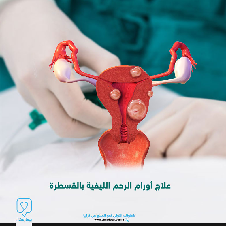 Treatment of uterine fibroids by catheterization in Turkey