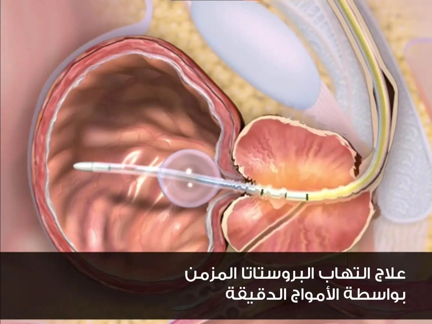 علاج التهاب البروستات المزمن بواسطة الأمواج الدقيقة من أحدث طرق العلاج في تركيا