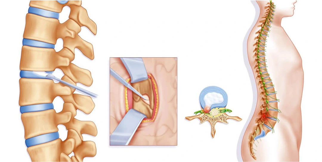 Endoscopic disc treatment is one of the latest treatment methods