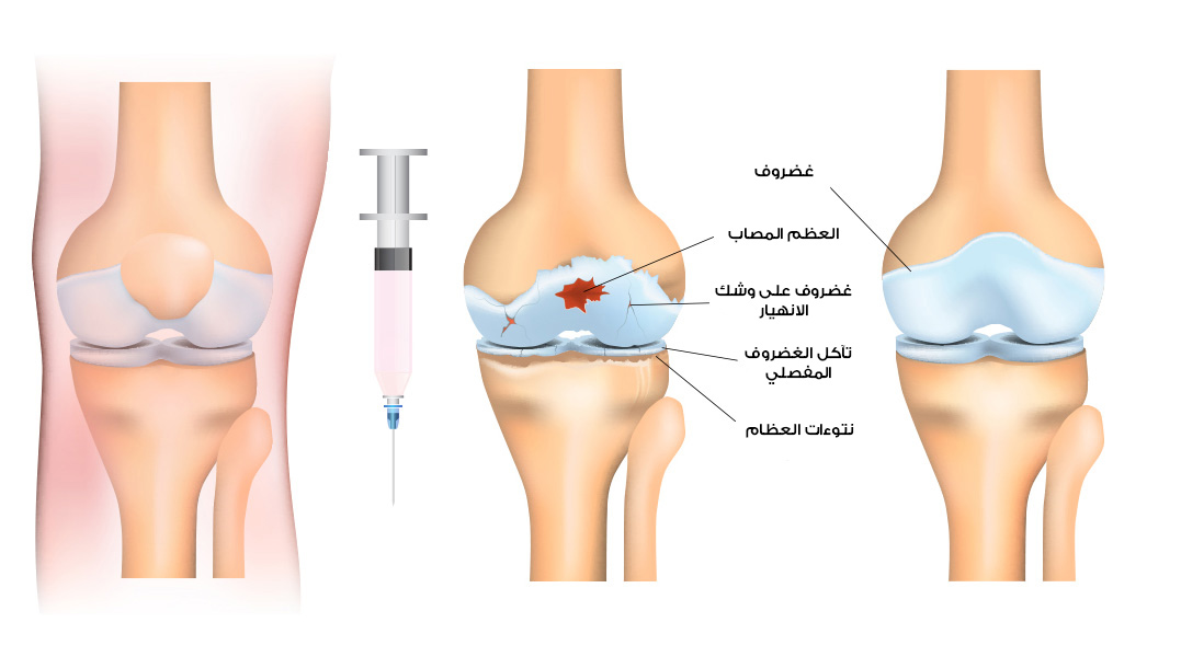 علاج المفاصل بالخلايا الجذعية