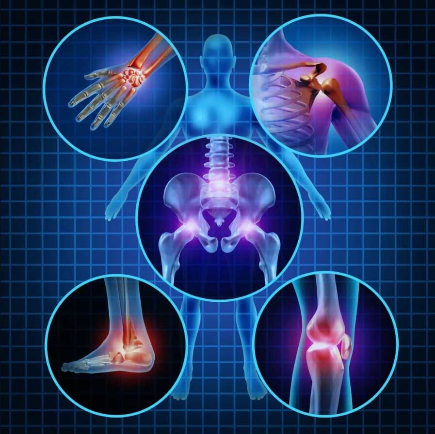 An illustration of arthritis in the body