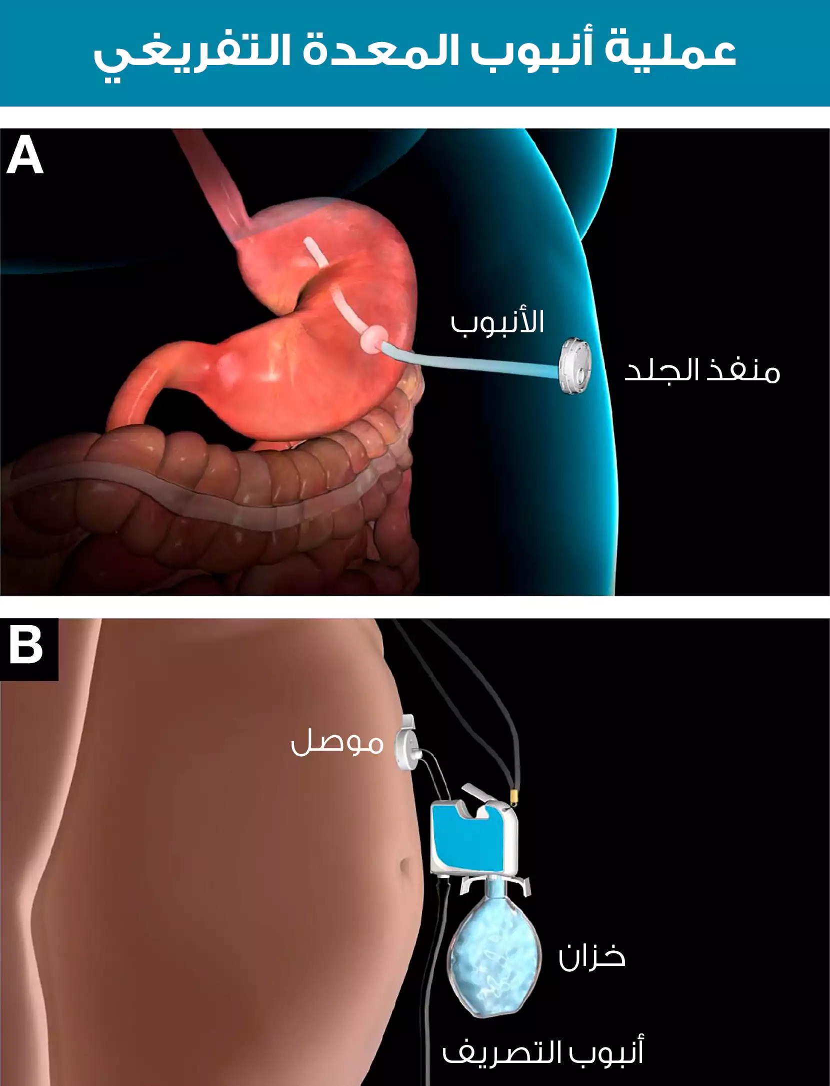 A picture of how the gastric emptying tube works and empties most of the food without digesting it