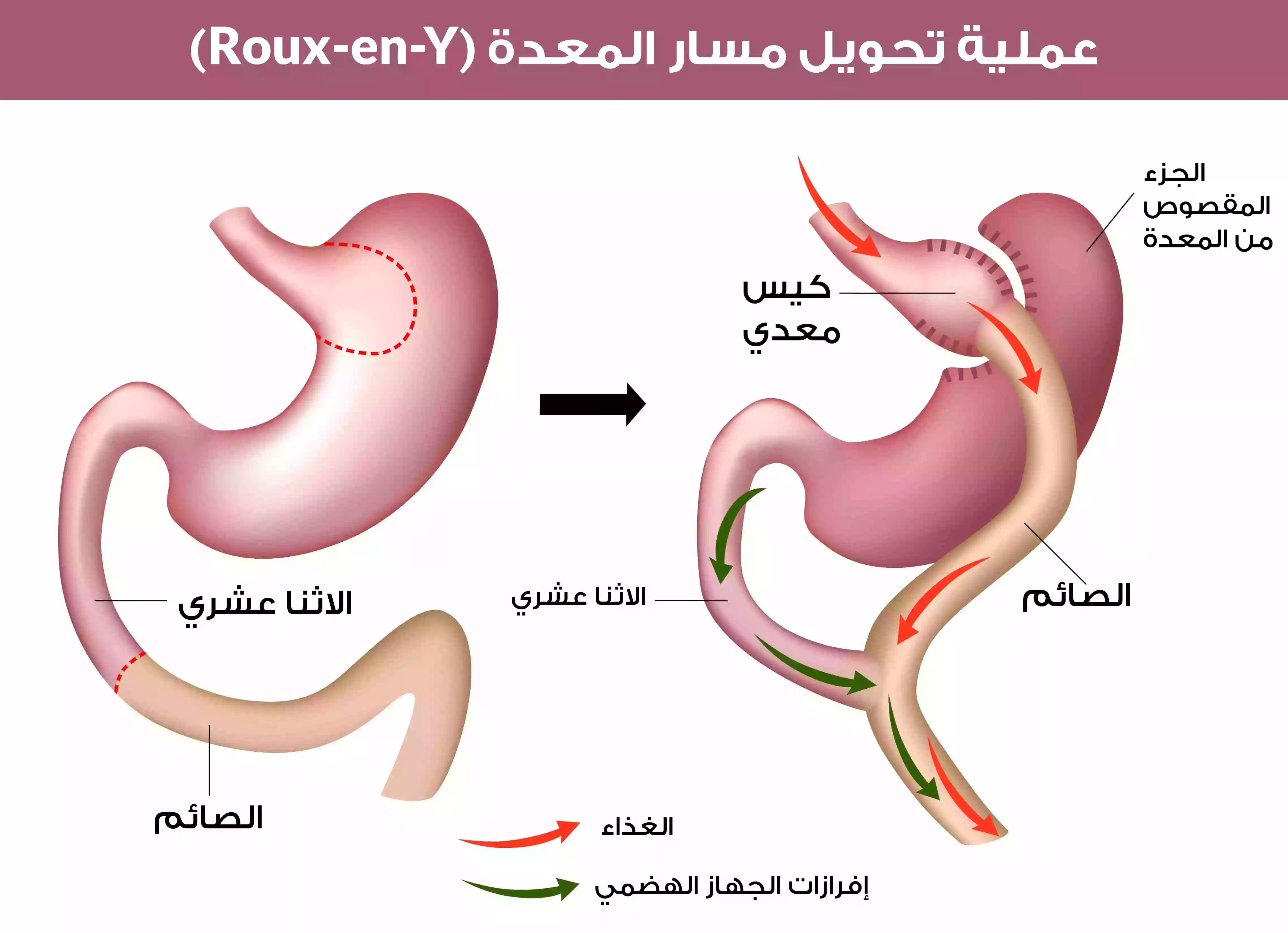 عملية تحويل مسار المعدة (Roux-en-Y) وهي من أشهر عمليات جراحة السمنة