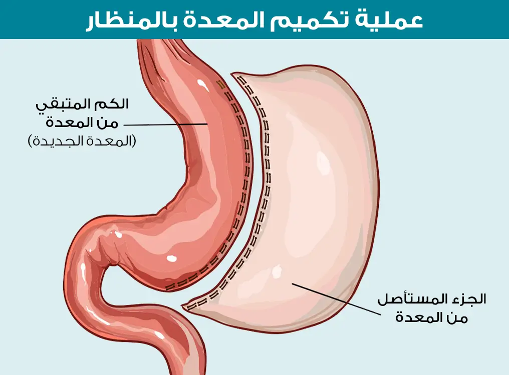 Laparoscopic sleeve gastrectomy shows the remaining and cut portion of the stomach to reduce food intake and the stomach to accommodate it