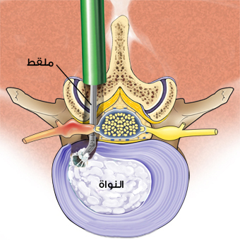 صورة توضح استئصال الغضروف المنزلق (الديسك) بالملقط مجهرياً