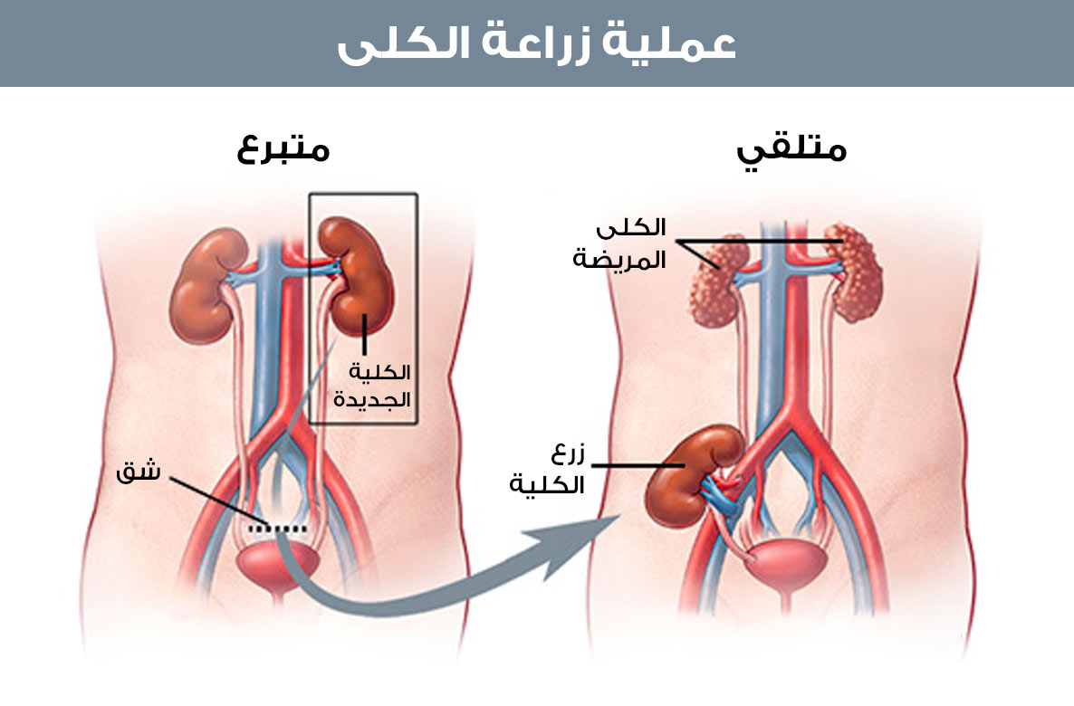 المتلقي والآخذ في عملية زراعة الكلى في تركيا