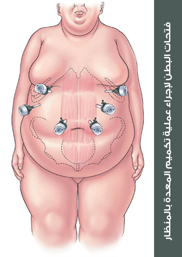 The locations of the incisions used in the abdomen for laparoscopic sleeve gastrectomy 