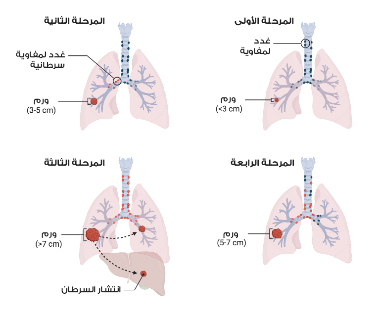 مراحل سرطان الرئة